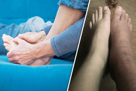 تورم مچ پا نشانه‌ای هشدار دهنده از وجود این بیماری