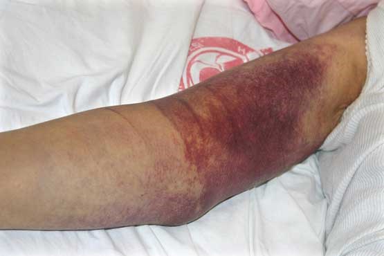 تائید مرگ بیمار زابلی به دلیل ابتلا به تب کریمه کنگو در یزد