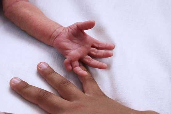 مشکلات پدر کارگر برای درمان نوزاد ۲۴ انگشتی +عکس