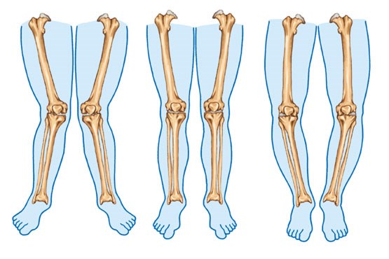 با پای پرانتزی، ایکس و دیگر اختلالات حرکتی آشنا شوید