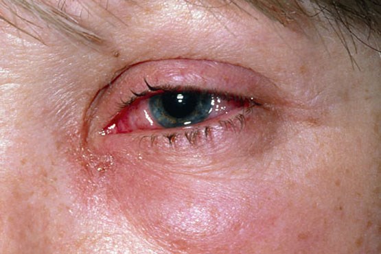 در چند ثانیه عفونت چشمتان را تشخیص دهید