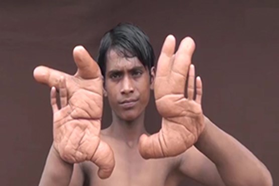 پسر بچه  هندی با دستهای غول پیکر