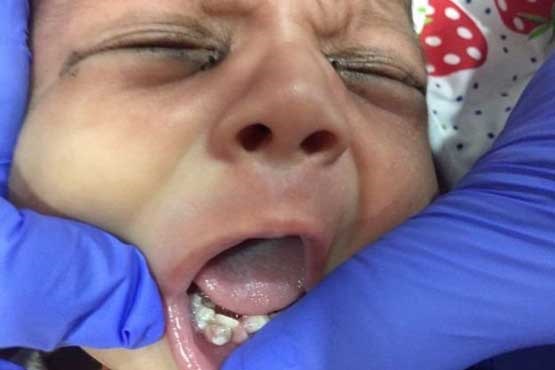 ۷ دندان نوزاد یکماهه کشیده شد