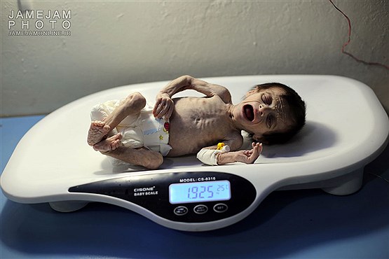 سوء تغذیه نوزاد سوری