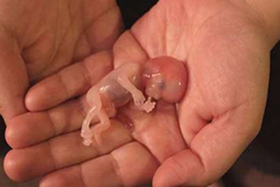 جنین سقط شده استثنایی در دستان پزشک