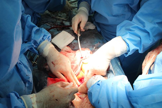 جراحی آخرین راه کاهش وزن / انواع جراحی برای کاهش اشتها