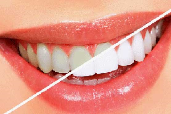 محصولات سفیدکننده دندان؛ سفید کننده دندان یا سیاه کننده روزگار؟!