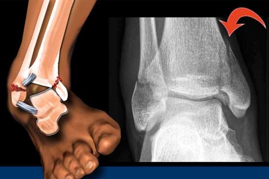 شکستگی مچ پا : توانبخشی و کاهش درد با  جراحی، ورزش، فیزیوتراپی