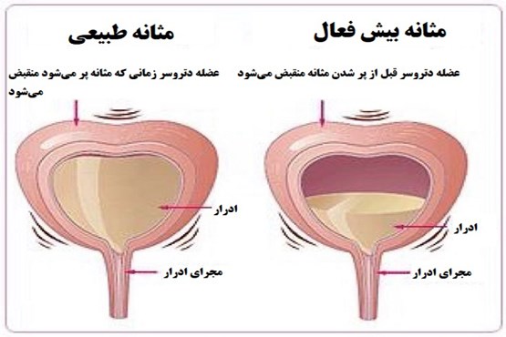 خوراکی‌های ممنوعه برای افراد دچار مشکل دفع ادرار