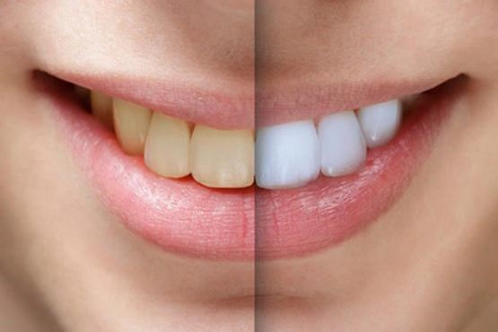 نکاتی مهم قبل از سفید کردن دندان ها