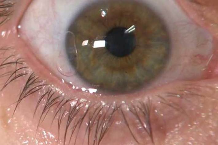 فوق تخصص چشم پزشکی با اشاره به اینکه قرمزی و یا التهاب چشم می‌تواند از نشانه‌های تهاجم ویروس کرونا باشد، گفت: ترشحات اشکی دقیقا مانند مخاط بینی عامل انتقال کروناست.