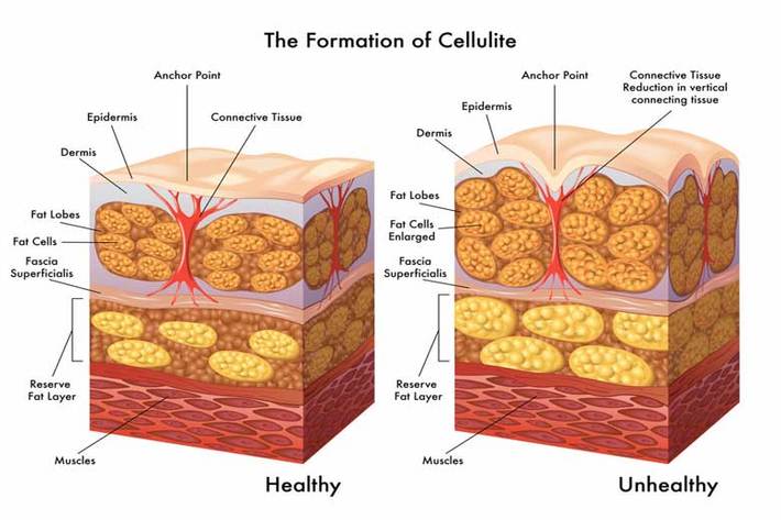 سلولیت بیماری‌ای است که بیشتر پزشکان آن را «بیماری کارمندی» می‌نامند حالا در کمین تمام کسانی است که دورکاری می‌کنند، زیاد در خانه تحرک ندارند یا به هر دلیلی ورزش را با تعطیل شدن باشگاه‌ها کنار گذاشته‌اند.سلولیت در واقع سلول‌های کلاژن بزرگ شده کروی شکل، بین پوست و ماهیچه است.