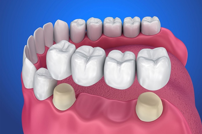 انواع روش های کاشت دندان