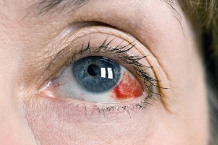 لکه های قرمز در سفیدی چشم به دلیل بزرگ شدن و گشاد شدن عروق موجود در سطح اسکرا (قسمت سفید چشم) ایجاد می شود.مدت زمان ایجاد علایم، یک یا دوطرفه بودن، حاد یا مزمن بودن، سن، و ... در تشخیص این عارضه مهم است.