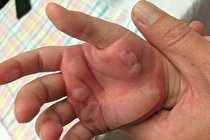 مرگ مشکوک دختر ۳ساله با آب‌جوش