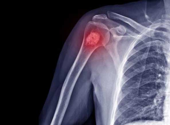 معرفی انواع سرطان ها و تومورهای استخوانی معرفی انواع سرطان ها و تومورهای استخوانی