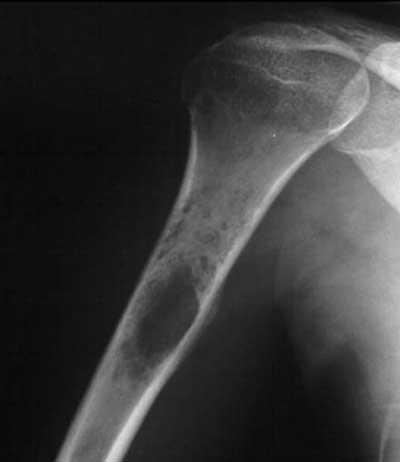 معرفی انواع سرطان ها و تومورهای استخوانی معرفی انواع سرطان ها و تومورهای استخوانی