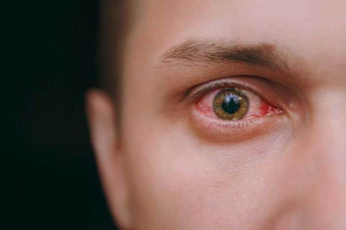 عضو هیات علمی دانشگاه علوم پزشکی ایران از علایم جدید بیماری کرونا را قرمزی چشم عنوان کرد و گفت: ممکن است بیمار مبتلا به این ویروس فقط این علامت را از خود بروز دهد و هیچ نشانه دیگری از بیماری نداشته باشد.