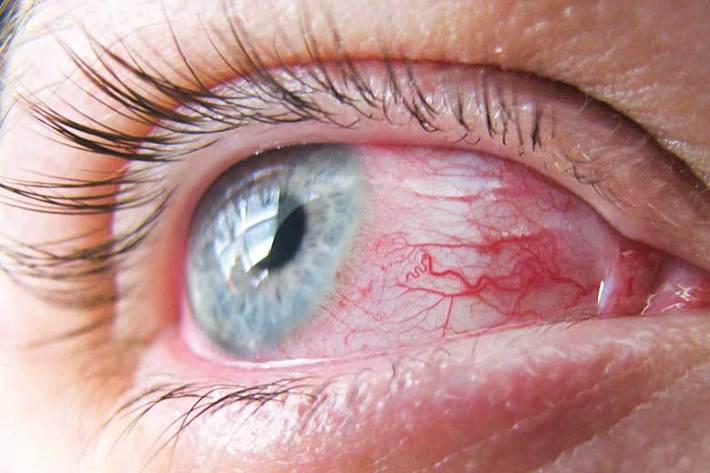 اصطلاح «چشم‌ صورتی» از آن دست عناوینی است كه با شیوع بیماری كووید - 19، توجه جامعه پزشكی و مردم دنیا را به خود جلب كرد. در واقع معلوم شد كه قرمزی یا التهاب چشم می‌تواند از نشانه‌های تهاجم ویروس كرونا باشد و این‌كه ترشحات اشكی دقیقا مانند مخاط بینی می‌تواند عامل انتقال بیماری كووید- 19 باشد.