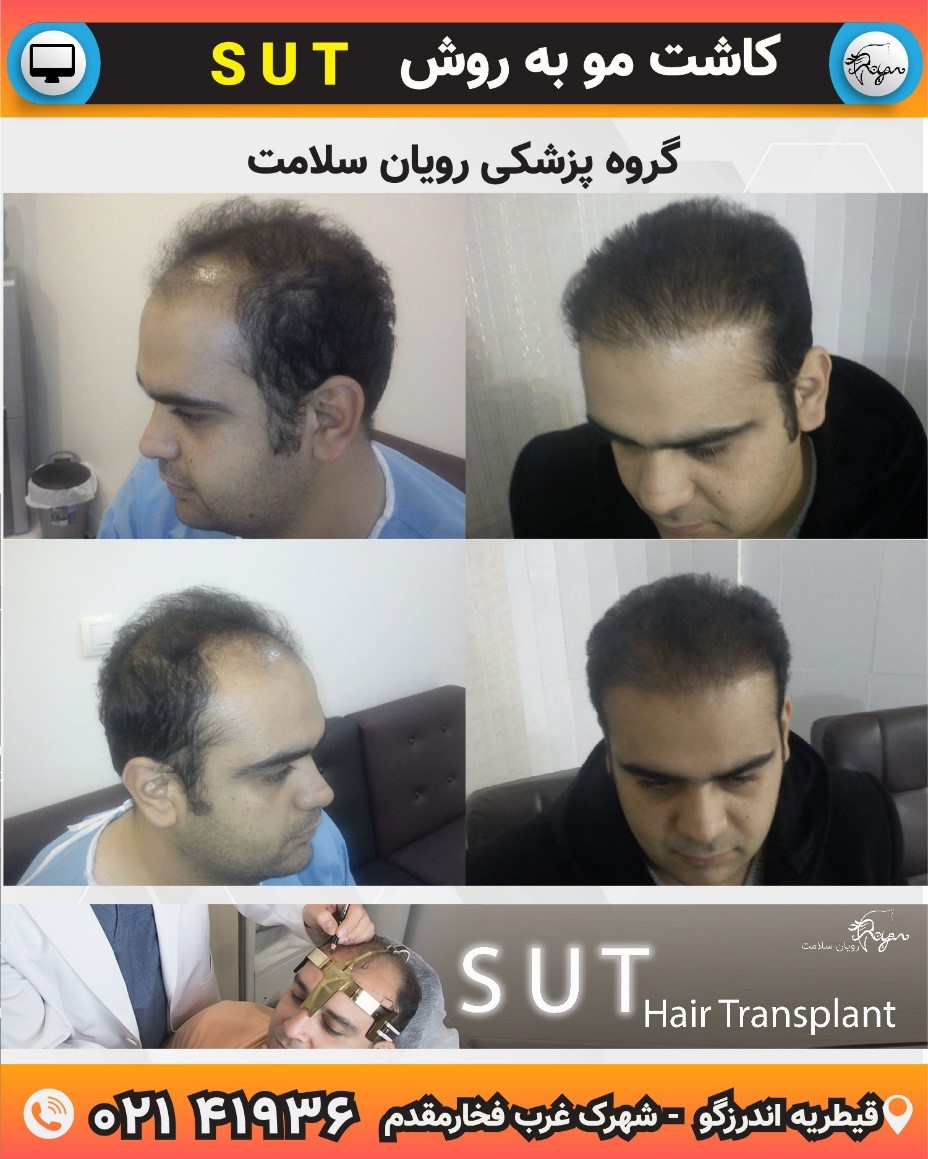 آیا نتایج کاشت مو دائمی است؟ آیا نتایج کاشت مو دائمی است؟