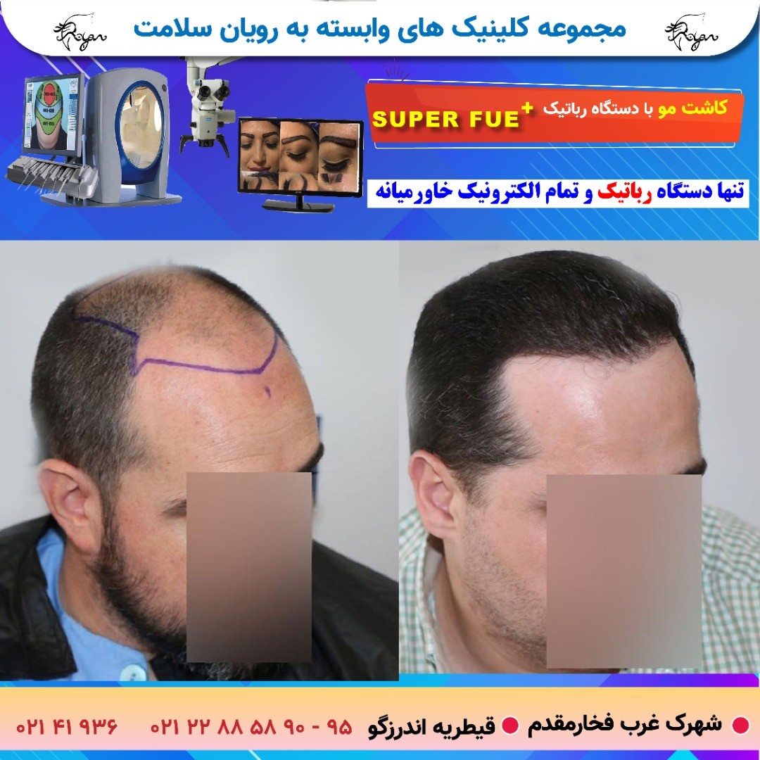 آیا نتایج کاشت مو دائمی است؟ آیا نتایج کاشت مو دائمی است؟