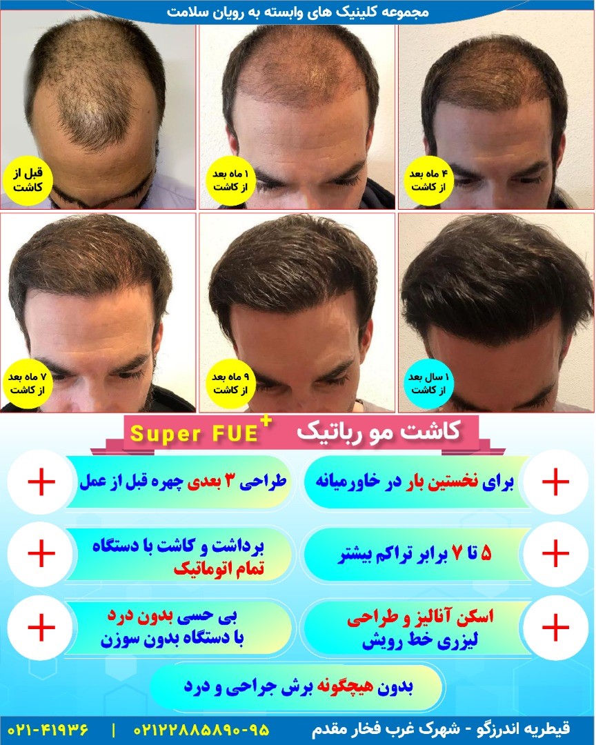 آیا نتایج کاشت مو دائمی است؟ آیا نتایج کاشت مو دائمی است؟