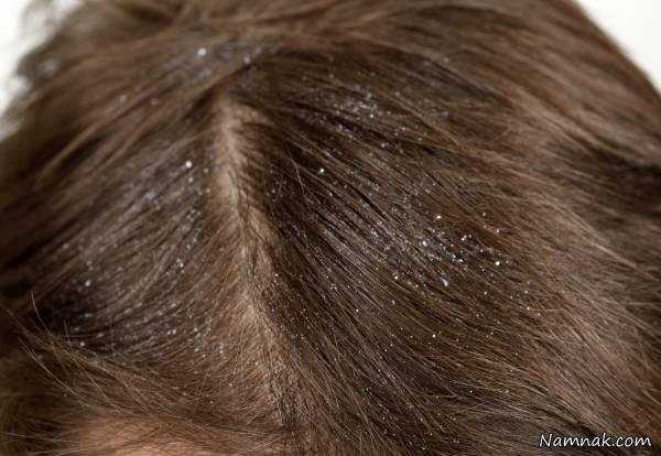 علت شوره سر و درمان آن به روش های کاملا طبیعی علت شوره سر و درمان آن به روش های کاملا طبیعی