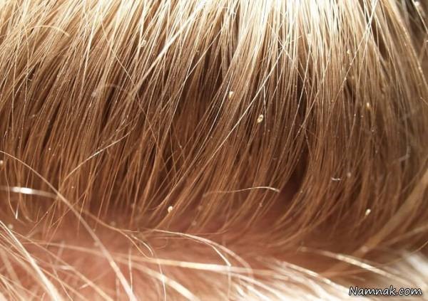 علت شوره سر و درمان آن به روش های کاملا طبیعی علت شوره سر و درمان آن به روش های کاملا طبیعی