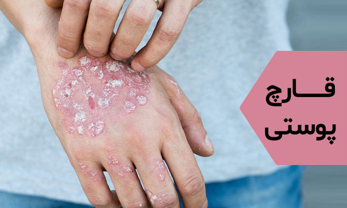 قارچ پوست یک عفونت بسیار مسری است که می تواند با تماس فرد دیگری منتقل شود. درمان این بیماری بسیار مهم است زیرا ممکن است در تمام بدن گسترش یابد و منجر به عوارض دیگری شود.