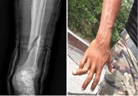 علت تشدید درد در سرما پس از شکستگی مچ دست من چیست