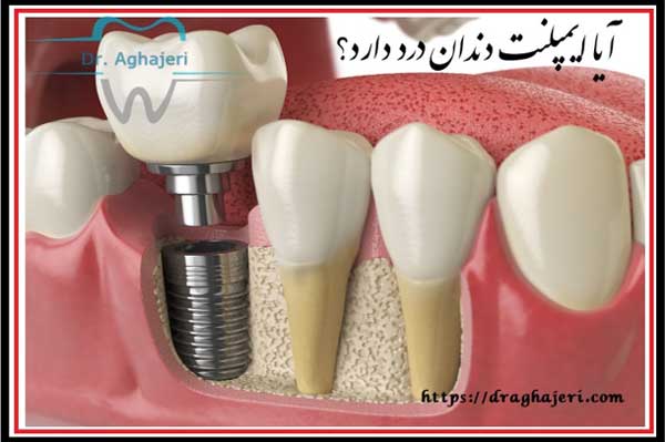 از سیر تا پیاز ایمپلنت دندان !!