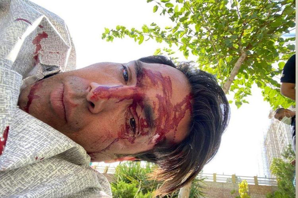 سلفی از صورت خونین؛ آخر چرا؟! (عکس)