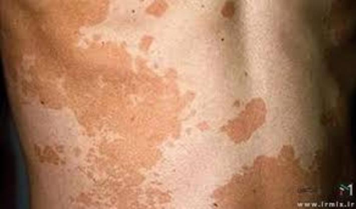  تنیا ورسیکالر، همچنین تغییر رنگ پوست هم نامیده می شود، یک عفونت شایع  قارچی  پوست است. در هر شخصی میتواند بوجود آید، اما در نوجوانان و بزرگسالان جوان شایعتر است.