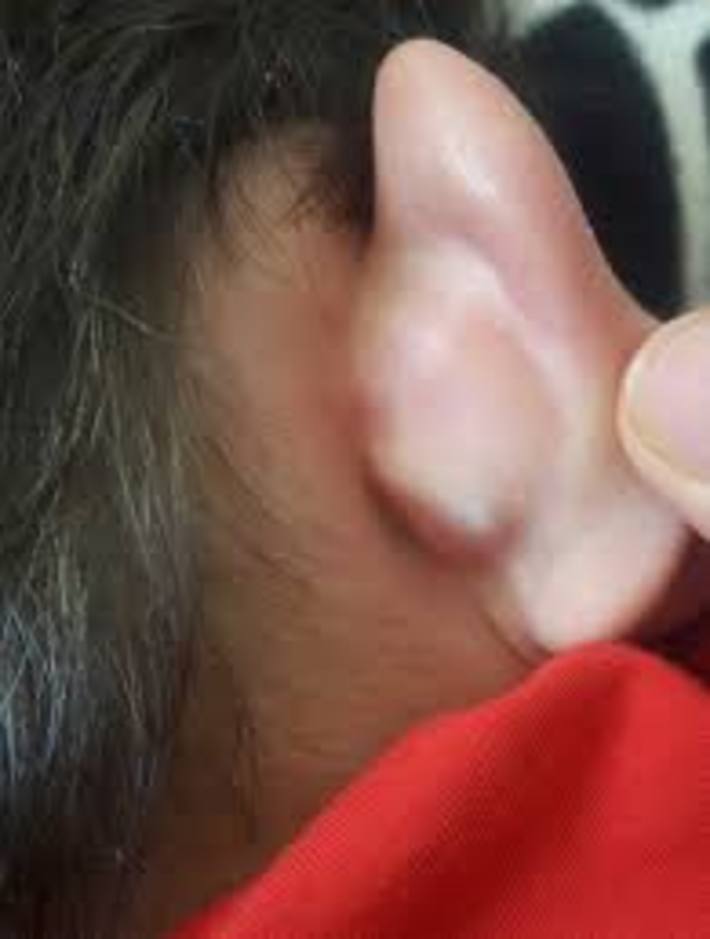 برآمدگى پشت گوش می تواند دلایل زیادی داشته باشد، ممکن است در زمان ابتلا به عفونت، رشد بیش از حد استخوانها، به دلیل حساسیت، یا در نتیجه برخى از انواع سرطانها، برآمدگى هاى دردناک یا بدون دردى در پشت گوش ایجاد شود.