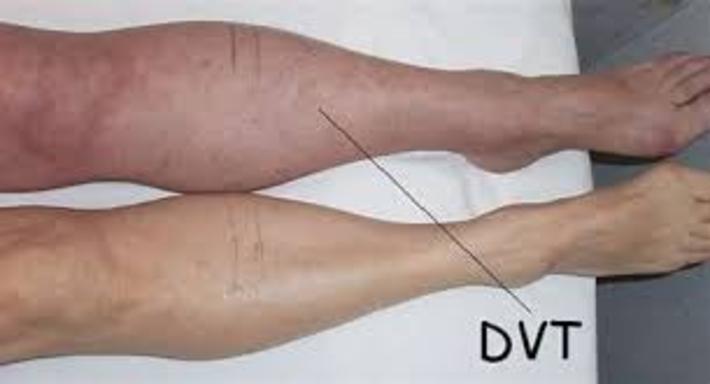 عمده‌ترین آنها در ساق پا پدید می‌آید. نتیجه ترومبوز در وریدهای عمقی که در پزشکی DVT نامیده می‌شوند، مشکلات متعددی در عضو است که جریان خون آن به‌دلیل ایجاد لخته، کم یا قطع می‌شود و بسته به عضو درگیر، علائم متفاوتی خواهد داشت.