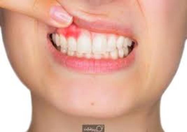 لثه یا (gums) نوعی بافت نرم و گوشتی است که از دندان حمایت و محافظت می‌کند. درد لثه می‌تواند نشانه تحریک، عفونت یا آسیب دیدگی به ساختار و بافت لثه یا دندان‌ها باشد. این درد اغلب می‌تواند یک علامت موقتی و گذرا باشد. اما در برخی موارد، شخصی که دچار لثه درد می‌شود بهتر است که برای پیشگیری از بروز مشکلات جدی تر، به یک دندانپزشک مراجعه کند.