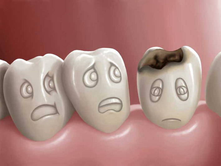 پوسیدگی دندان مشکلی آزار دهنده برای اغلب افراد است، اما روش های جلوگیری از پوسیدگی دندان چیست و چگونه می توان از پوسیدگی دندان جلوگیری کرد؟