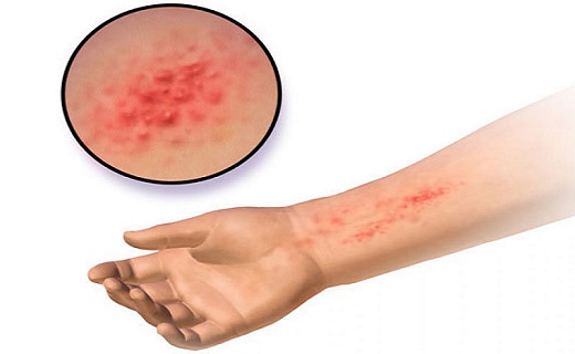 بیماری خطرناکی که در مواجهه با سرما پدید می‌آید