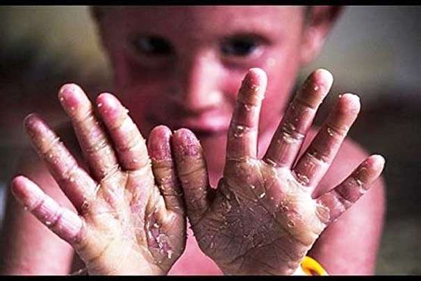 جراحی پلاستیک ۲۲۰ بیمار پروانه ای در شیراز جراحی پلاستیک ۲۲۰ بیمار پروانه ای در شیراز