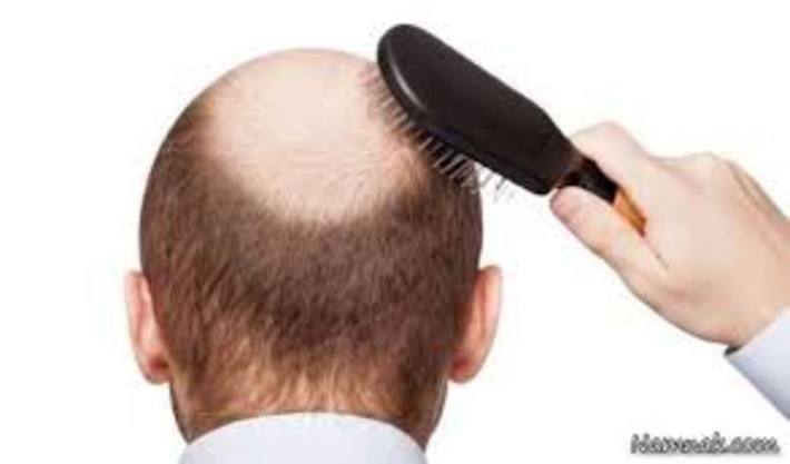 درمان ریزش مو با استفاده از طب سنتی امروزه مورد توجه بسیاری از افراد قرار گرفته است. برای درمان ریزش مو می‌بایست مواد غذایی مفید و مناسب مصرف نمود تا به مو‌ها و ریشه‌های آن مواد مغذی کافی برسد. معمولاً کسانی که دچار بیماری می‌شوند، به علت اختلال در تغذیه، دچار ریزش مو (Hair loss) می‌شوند.