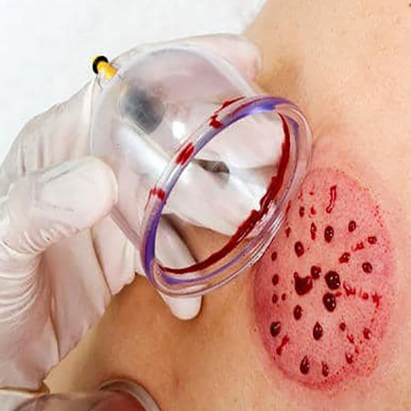 علائم نیاز بدن به حجامت در پاییز