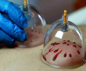 علائم نیاز بدن به حجامت در پاییز