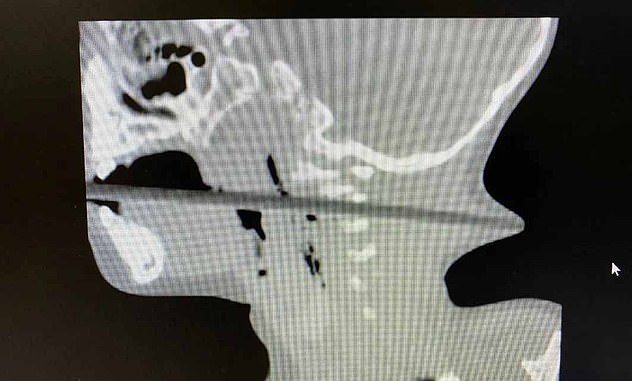 فرو رفتن چوب غذا خوری  چاپستیک در گلوی پسر ۲ ساله