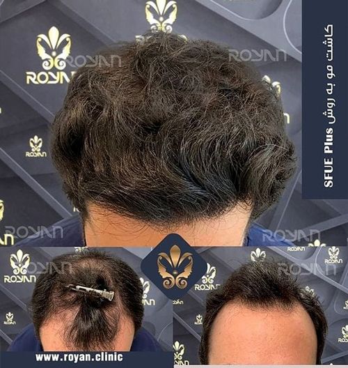 با جدیدترین روش کاشت موی جهان آشنا شوید !