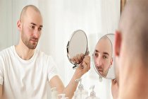 بهترین زمان برای کاشت مو چه سنی است؟