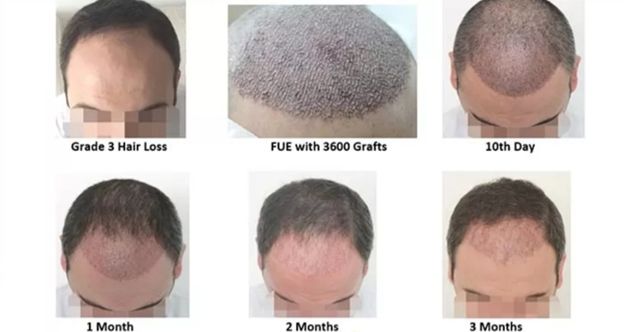 آیا نتایج کاشت مو دایمی است چه مدت بعد از کاشت مو میتوانید به نتیجه دلخواه برسید