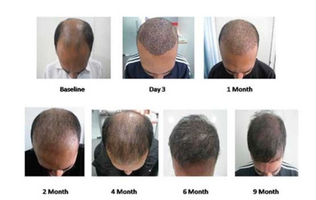 آیا نتایج کاشت مو دایمی است چه مدت بعد از کاشت مو میتوانید به نتیجه دلخواه برسید