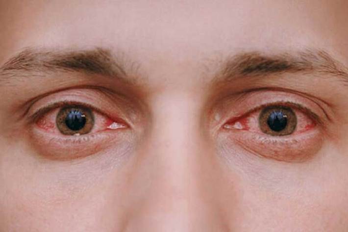 دلایل اصلی قرمزی چشم چیست؟ + درمان