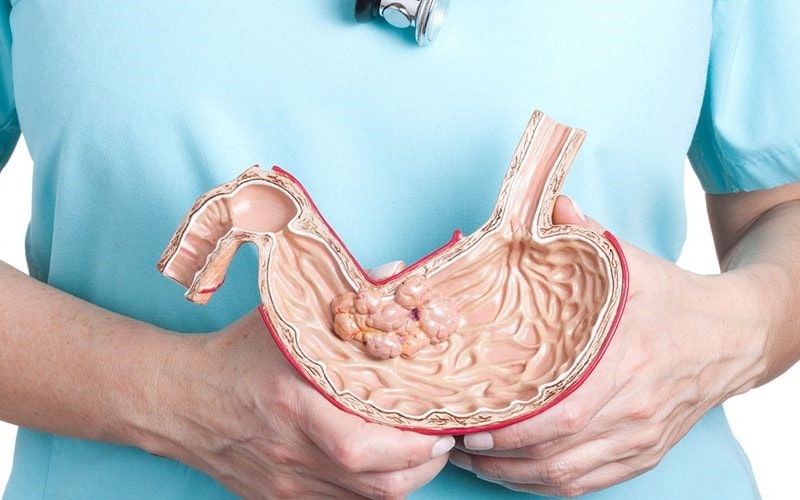 مزایای اسلیو معده