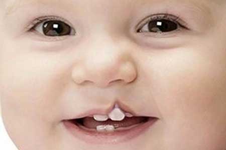 شکاف لب و کام درمان‌شدنی است